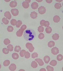 This is a photo of one of Gao Gao’s healthy white blood cells, surrounded by normal red blood cells.