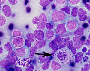 This high magnification photomicrograph shows a single tumor cell undergoing mitosis (cell division), a characteristic that indicates tumor growth. The dark purple material at the center of the cell is the nucleus beginning to divide.