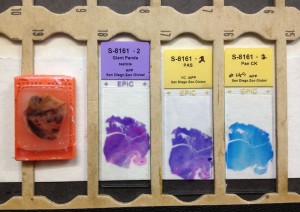 On the left is the paraffin wax block containing the processed tumor tissue, which is then cut into thin slices (about the width of a human hair) by our histotechnologist. These thin sections are then stained by several different methods to allow microscopic evaluation of the cells in the tumor.